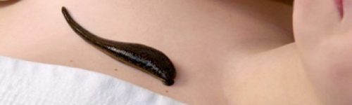 leeches and leech therapy